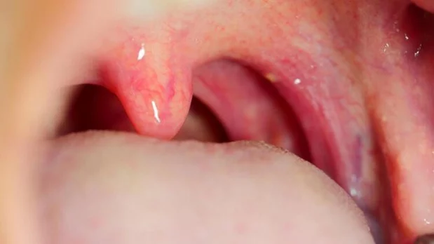 Michy Batshuayi'nin hastalığı akut tonsilit hakkında bilgiler!